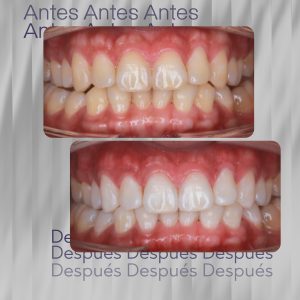 Blanqueamiento Dental Philips Zoom Whitespeed