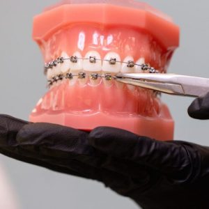 30% dcto Tratamiento Ortodoncia Fija